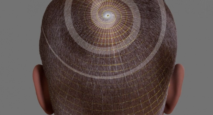 The Latest Technique Targeting Naturalness “Archimedes Hair Transplantation”