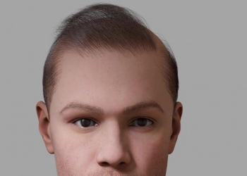 Why Doesn't Hair Transplant Look "Natural"?