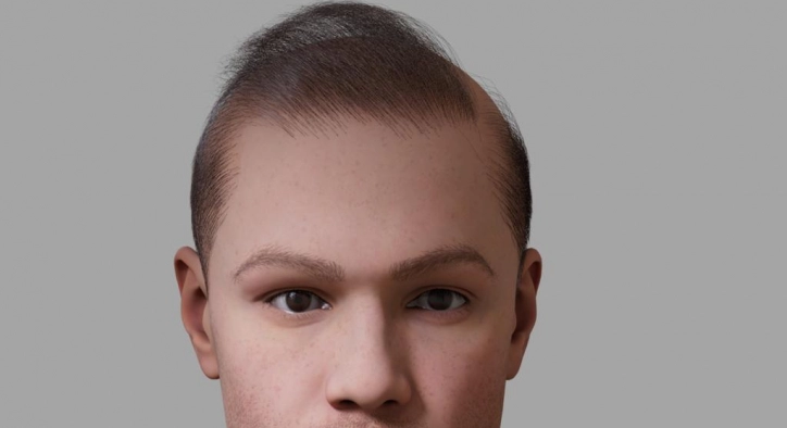 Why Doesn't Hair Transplant Look "Natural"?